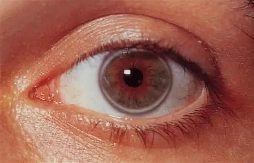 Роговичная дуга.