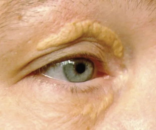 Ксантомы и ксантолазмы. На веке