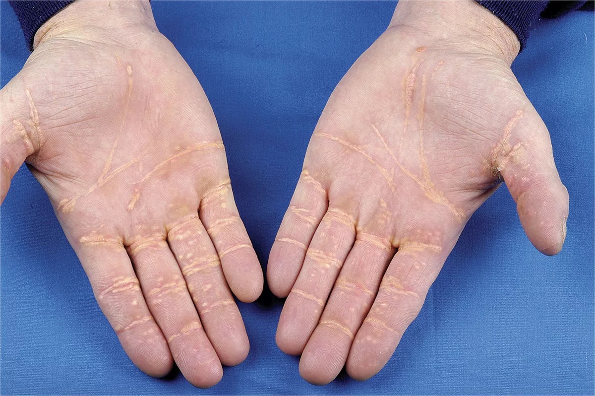 Ксантомы и ксантолазмы. На руках